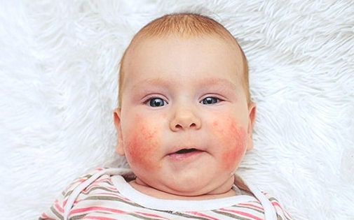 Bebeklerde Alerjik Gıdalar